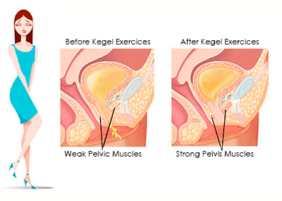 Before and After Kegel Exercises