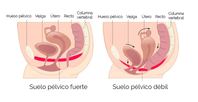 Suelo Pélvico Fortalecido VS Suelo Pélvico Débil